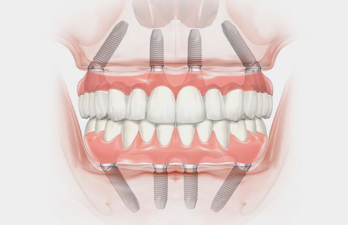 Nobel Biocare All-on-4