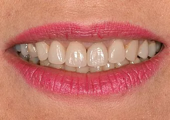 Celokeramické korunky CEREC Empress Multi