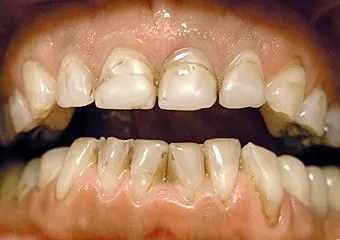 Vollkeramische Kronen CEREC Empress Multi