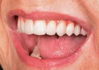 festsitzender Zahnersatz auf vier Implantaten
