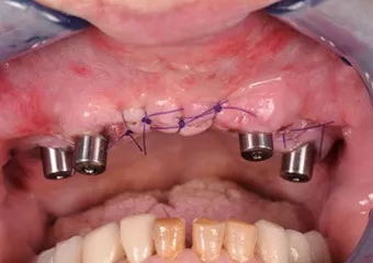 All-on-4, Astra Tech, fixed teeth on four implants