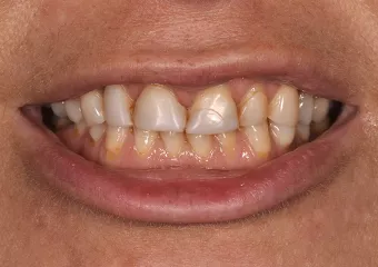 Vollkeramische Zahnkrone e.max