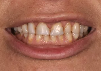 All-ceramic crowns e.max