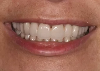 All-ceramic crowns e.max