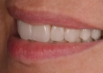 Vollkeramische Zahnkrone e.max