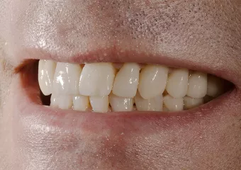 Complete reconstruction of teeth