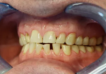 Complete reconstruction of teeth