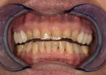 Replacement of damaged teeth