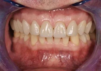 Replacement of damaged teeth