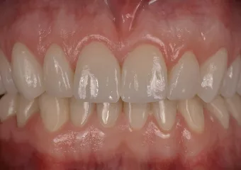 Complete reconstruction of teeth