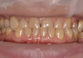 All-ceramic crowns