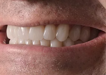 Complete reconstruction of teeth