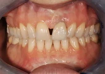 Vollkeramische Zahnkronen e.max – Interdentalspalt