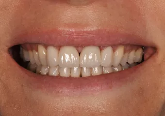 Vollkeramische Zahnkronen e.max – Interdentalspalt