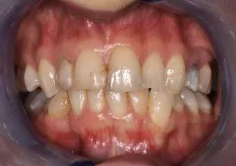 Prosthetic correction e.max