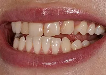 DSD planning, all-ceramic veneers and e.max crowns