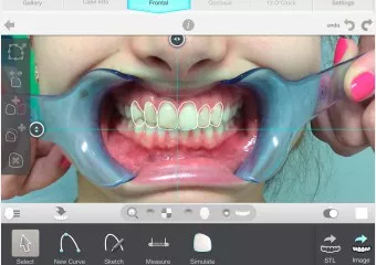DSD planning, all-ceramic veneers and e.max crowns