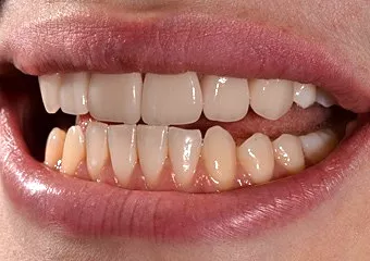 DSD planning, all-ceramic veneers and e.max crowns