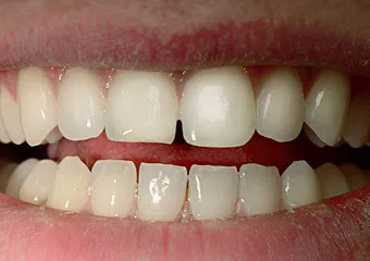 All-ceramic veneer