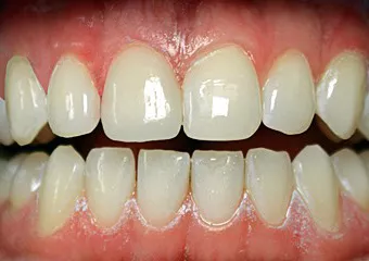 All-ceramic veneer