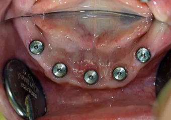 Dentis dental implants + Brenemark bridge