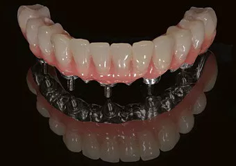 Dentis dental implants + Brenemark bridge