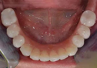 Zubní implantáty Dentis + Brenemarkův můstek