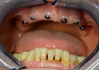 ASTRA TECH dental implants + zirconium bridge