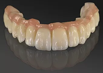 ASTRA TECH dental implants + zirconium bridge