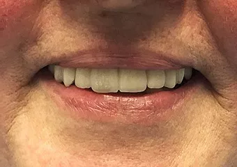 Zahnimplantate ASTRA TECH + Zahnbrücke aus Zirkon