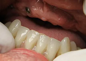Celokeramický zirkonový můstek a zubní implantáty