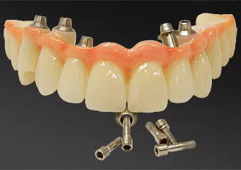 All-ceramic zirconia bridge and dental implants