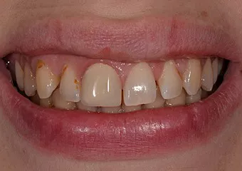 Combination of glass ceramic crown, veneer and composite fillings