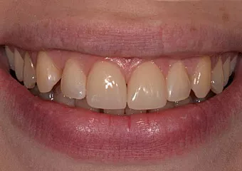 Combination of glass ceramic crown, veneer and composite fillings