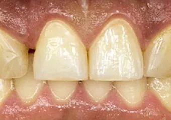 Ceramic veneers, bite enhancement, e.max material