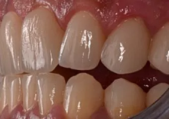 Ceramic veneers, bite enhancement, e.max material