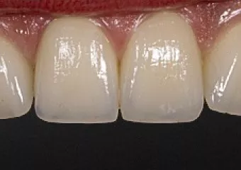 Ceramic veneers, bite enhancement, e.max material