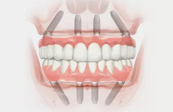 Nobel Biocare All-on-4 Implants Astra Tech